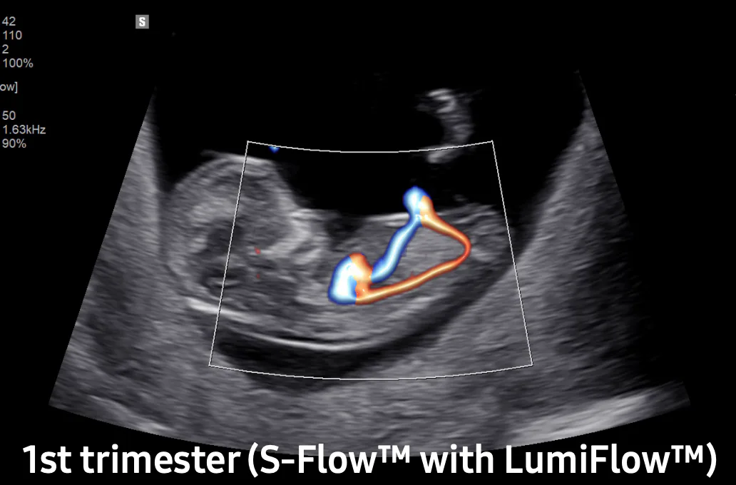 فناوری Lumi-Flow و S-Flow در دستگاه سونوگرافی سامسونگ Samsung V8